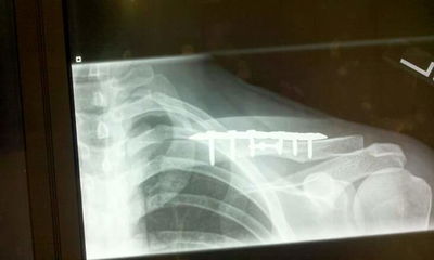 Kevin's X-ray... ouch!