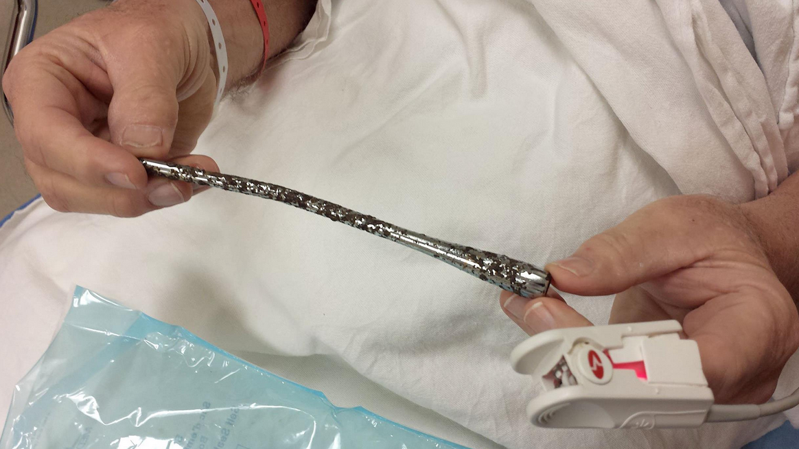 This Man Had A Metal Indicator Stalk In His Arm For 51 Years